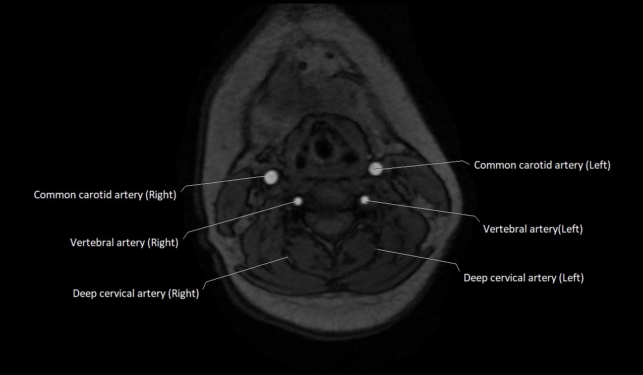Carotid artery anatomy axial 3T image 34.jpg
